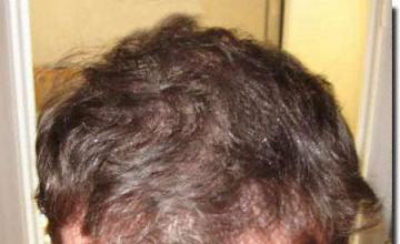 Hair restoration procedure results