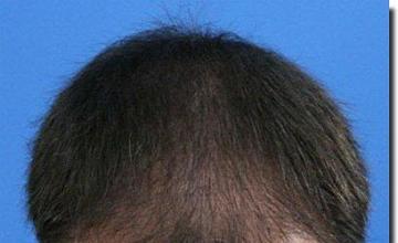 Hair restoration procedure results