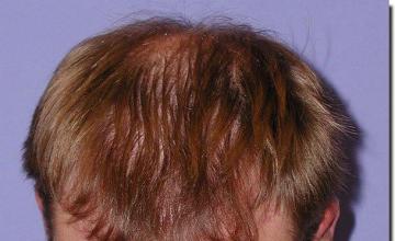 Hair restoration procedure results