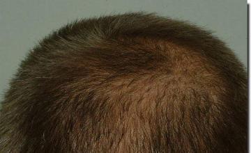 Hair restoration procedure results