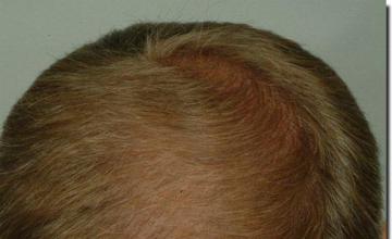 Hair restoration procedure results