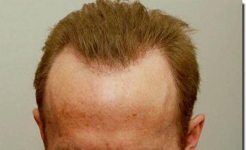 Hair restoration procedure results