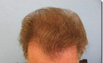 Hair restoration procedure results