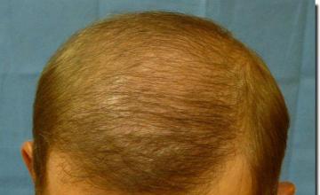 Hair restoration procedure results