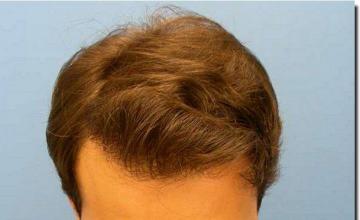 Hair restoration procedure results