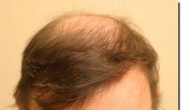 Hair restoration procedure results