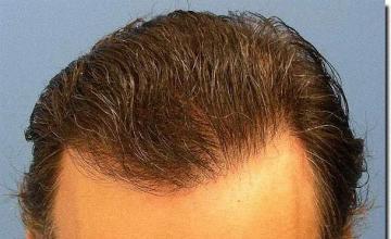 Hair restoration procedure results