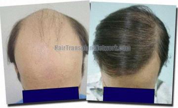 Hair restoration procedure results