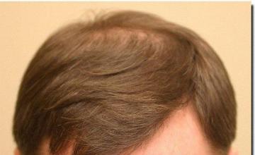 Hair restoration procedure results