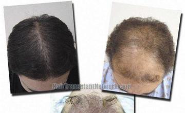 Hair restoration procedure results