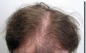 Hair restoration procedure results