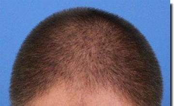 Hair restoration procedure results