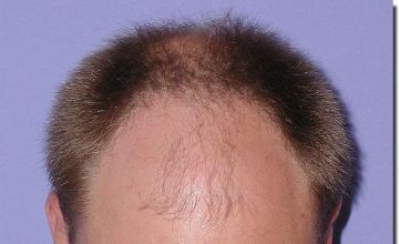 Hair restoration procedure results