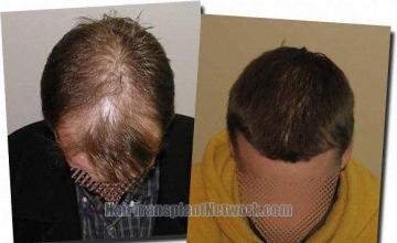Hair restoration procedure results