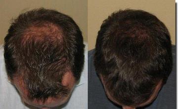 Hair restoration procedure results