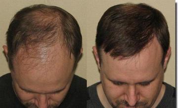 Hair restoration procedure results