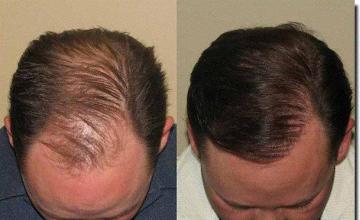 Hair restoration procedure results