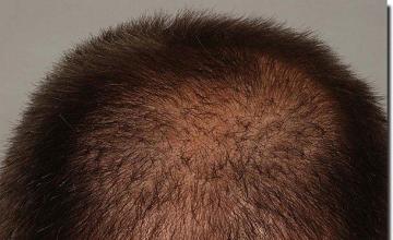 Hair restoration procedure results