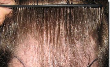 Hair restoration procedure results