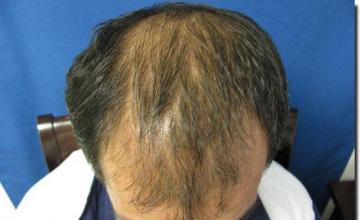 Hair restoration procedure results