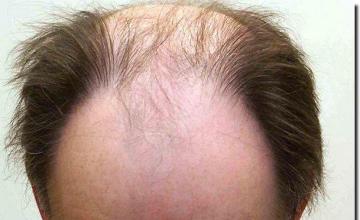 Hair restoration procedure results