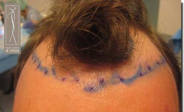 Hair restoration procedure results