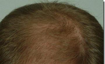 Hair restoration procedure results