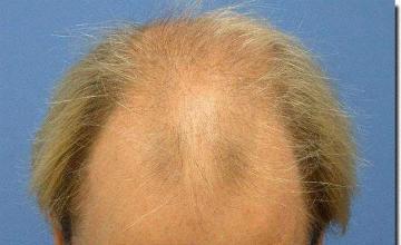 Hair restoration procedure results