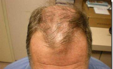 Hair restoration procedure results