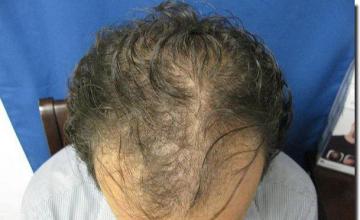 Hair restoration procedure results