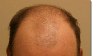 Hair restoration procedure results