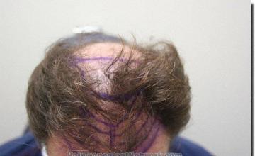 Hair restoration procedure results