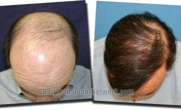 Hair restoration procedure results