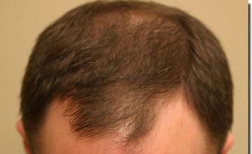 Hair restoration procedure results