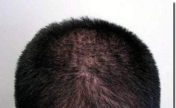 Hair restoration procedure results