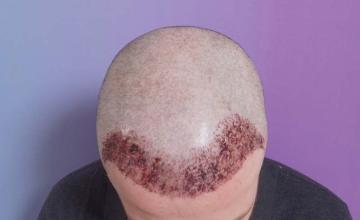 Top of head immediate post-op