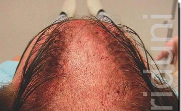 Hair restoration procedure results