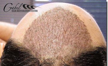 Hair restoration procedure results