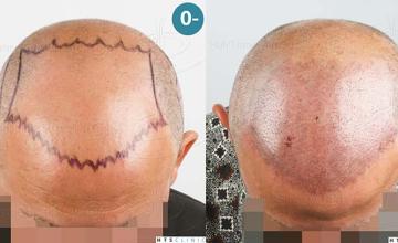 Top - planning and immediate post-op