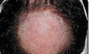 Hair restoration procedure results