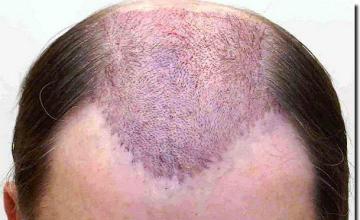 Hair restoration procedure results