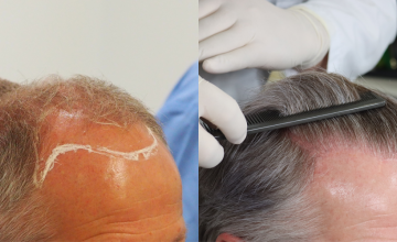 Right side before and after hair transplant