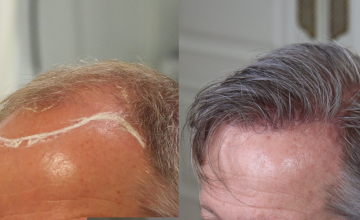 Left side before and after hair transplant