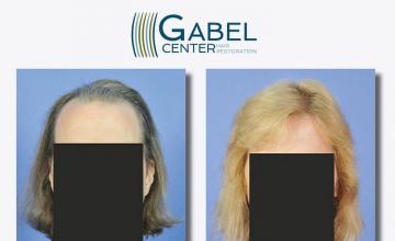 Hair restoration procedure before and after results