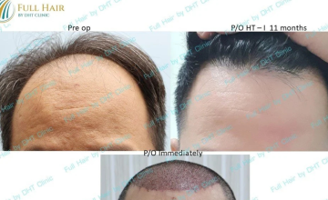 Before and After frontal view