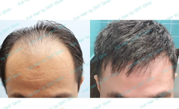 Before and After
