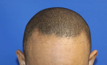 Before and After