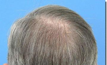 Hair restoration procedure results