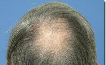 Hair restoration procedure results