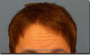 Hair restoration procedure results